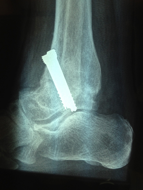 ankle-arthritis