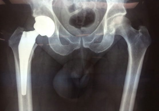 Direct Anterior Approach to the hip - Avalon Orthopaedic