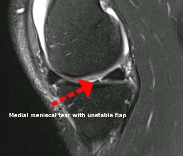 lateral-meniscal-tear-PM-new